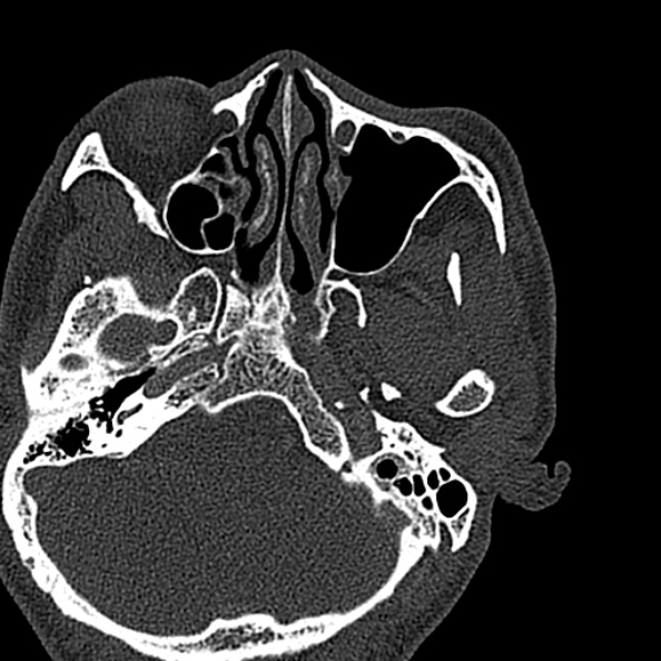 Ameloblastoma (Radiopaedia 51921-57766 Axial bone window 147).jpg
