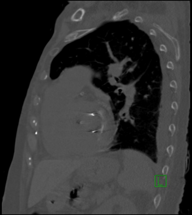 Amiodarone deposition in the liver (Radiopaedia 77587-89780 Sagittal bone window 35).jpg