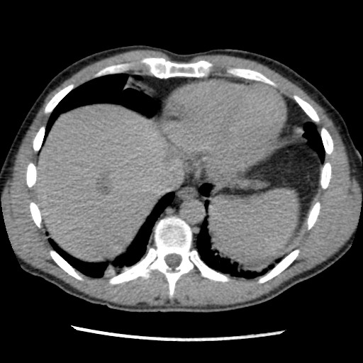 Amoebic liver abscesses (Radiopaedia 55536-62009 Axial C+ delayed 11).jpg
