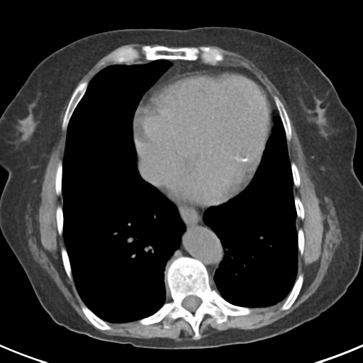 File:Ampullary adenocarcinoma (Radiopaedia 34013-35237 Axial non-contrast 1).png