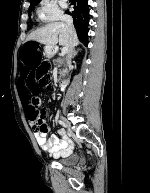 Ampullary adenocarcinoma (Radiopaedia 86093-102032 D 39).jpg