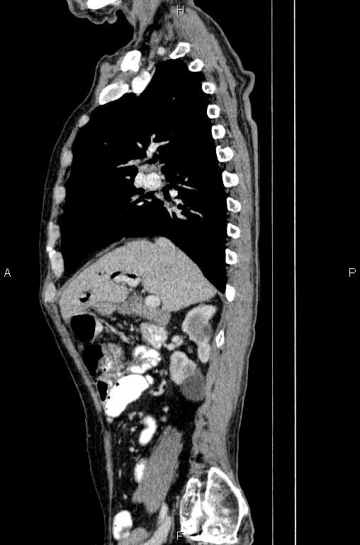 Ampullary adenocarcinoma (Radiopaedia 86093-102033 E 32).jpg