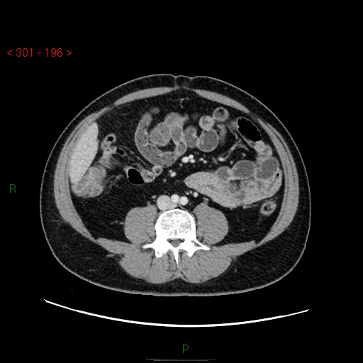 File:Ampullary carcinoma (Radiopaedia 56396-63056 C 58).jpg