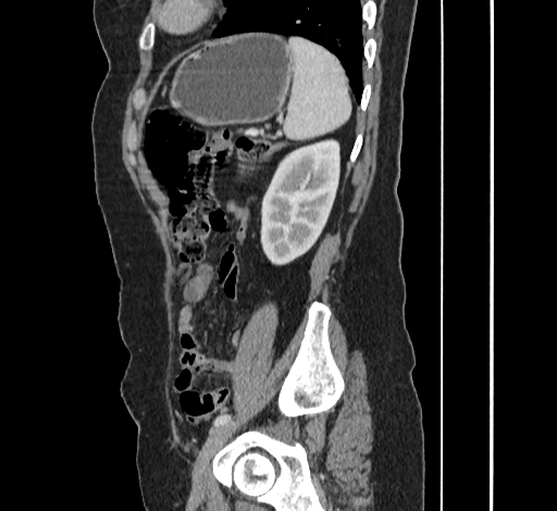File:Ampullary tumor (Radiopaedia 60333-67998 C 47).jpg