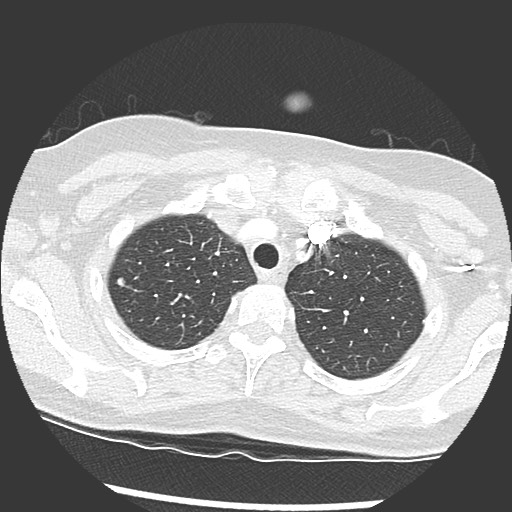 Amyloidosis - bronchial and diffuse nodular pulmonary involvement (Radiopaedia 60156-67745 Axial lung window 11).jpg