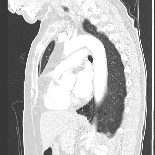Amyloidosis - bronchial and diffuse nodular pulmonary involvement (Radiopaedia 60156-67745 Sagittal lung window 51).jpg