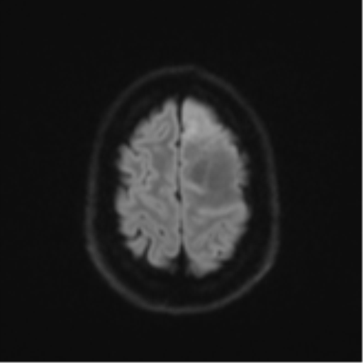 File:Anaplastic astrocytoma (Radiopaedia 57768-64731 Axial DWI 53).png