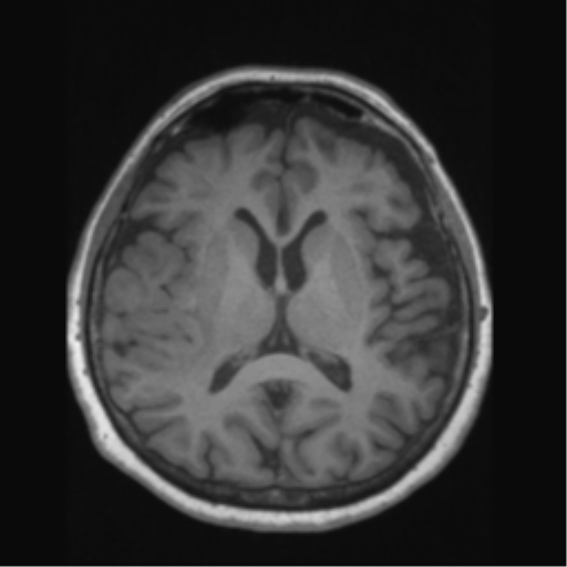 File:Anaplastic astrocytoma IDH wild-type (pseudoprogression) (Radiopaedia 42209-45276 Axial T1 85).png