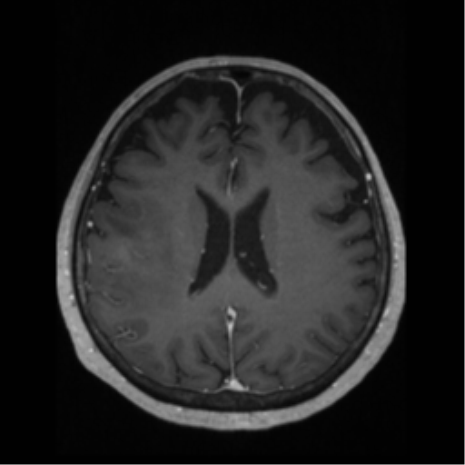 File:Anaplastic astrocytoma IDH wild-type (pseudoprogression) (Radiopaedia 42209-45276 Axial T1 C+ 93).png