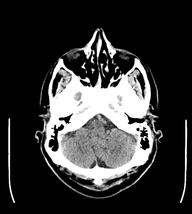 Anaplastic oligodendroglioma (Radiopaedia 79571-92753 Axial non-contrast 15).jpg