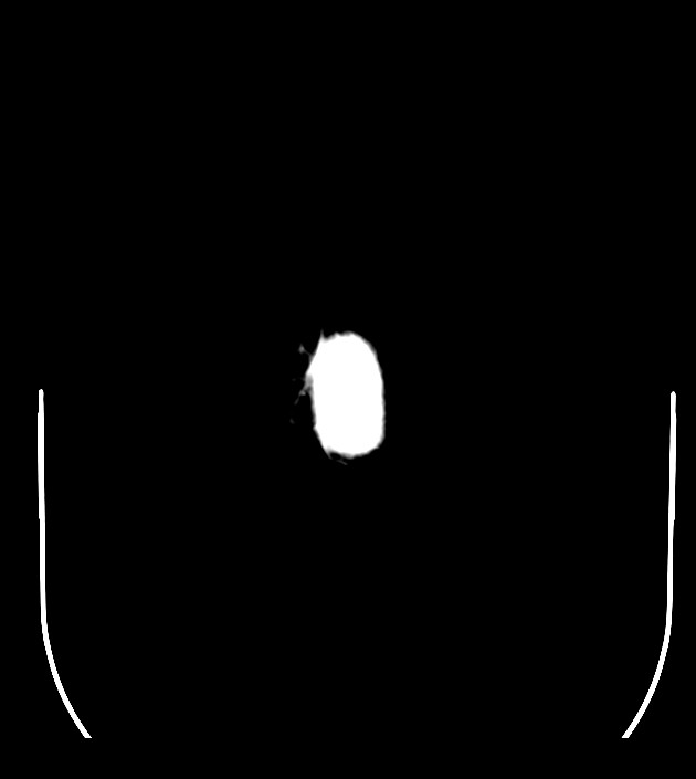 Anaplastic oligodendroglioma (Radiopaedia 79571-92755 Axial non-contrast 54).jpg