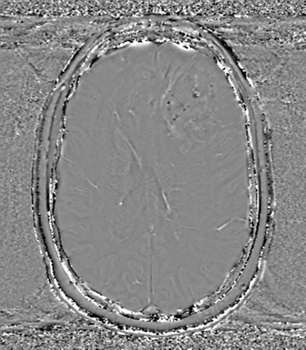 Anaplastic oligodendroglioma (Radiopaedia 83500-98599 Axial SWI - phase 51).png