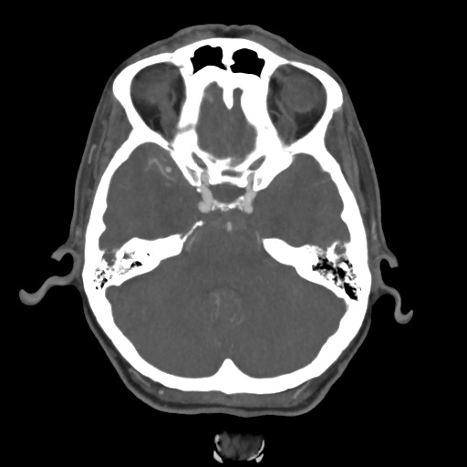 File:Aneursym related subarachnoid hemorrhage with hydrocephalus (Radiopaedia 45105-49084 A 17).jpg