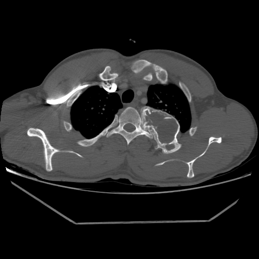 Aneurysmal bone cyst - rib (Radiopaedia 82167-96220 Axial bone window 69).jpg