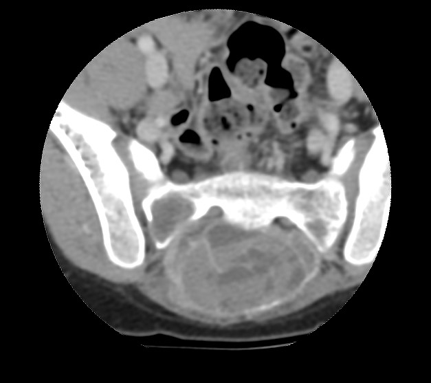Aneurysmal bone cyst - sacrum (Radiopaedia 65190-74195 Axial non-contrast 25).jpg
