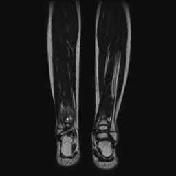 File:Aneurysmal bone cyst - tibia (Radiopaedia 22343-22367 Coronal T2 13).jpg