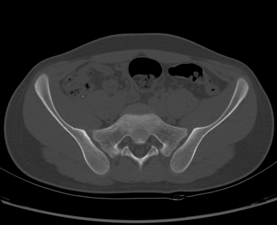 File:Aneurysmal bone cyst of ischium (Radiopaedia 25957-26094 Axial bone window 22).png