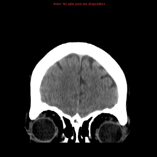 File:Aneurysmal subarachnoid hemorrhage (Radiopaedia 24740-24997 Coronal non-contrast 5).jpg