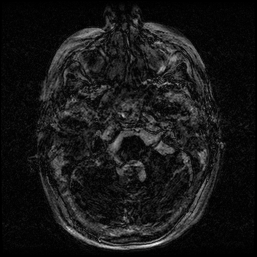 Angioinvasive aspergillosis in the pituitary fossa (Radiopaedia 39676-42010 Ax 3D FIESTA VOLUME 6).png