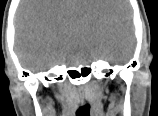 Angular dermoid cyst (Radiopaedia 88967-105790 Coronal non-contrast 68).jpg