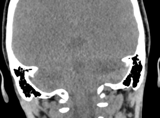 Angular dermoid cyst (Radiopaedia 88967-105790 Coronal non-contrast 90).jpg