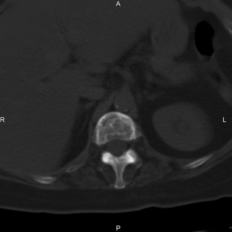 Ankylosing spondylitis (Radiopaedia 8748-9556 Axial bone window 18).jpg
