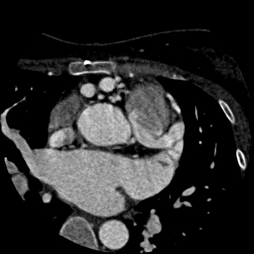 File:Anomalous left coronary artery from the pulmonary artery (ALCAPA) (Radiopaedia 40884-43586 A 16).jpg
