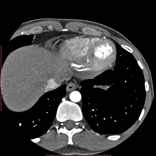File:Anomalous left coronary artery from the pulmonary artery (ALCAPA) (Radiopaedia 70148-80181 A 345).jpg
