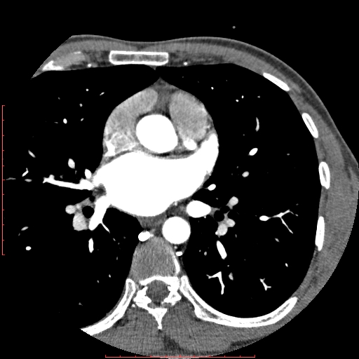 Anomalous left coronary artery from the pulmonary artery (ALCAPA) (Radiopaedia 70148-80181 A 96).jpg