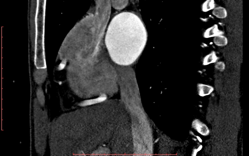 File:Anomalous left coronary artery from the pulmonary artery (ALCAPA) (Radiopaedia 70148-80181 C 56).jpg