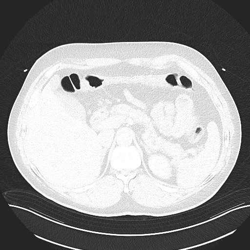 File:Anomalous origin of the left coronary artery with malignant course (Radiopaedia 77842-90126 Axial lung window 36).jpeg