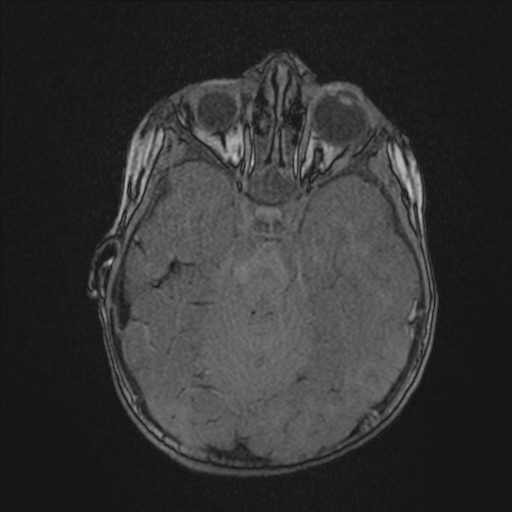 Anoxic brain injury (Radiopaedia 79165-92139 Axial MRA 75).jpg