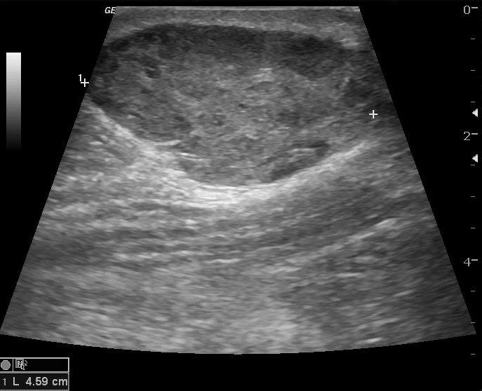 File:Anterior abdominal wall hematoma (Radiopaedia 11069-11472 B 1).jpg