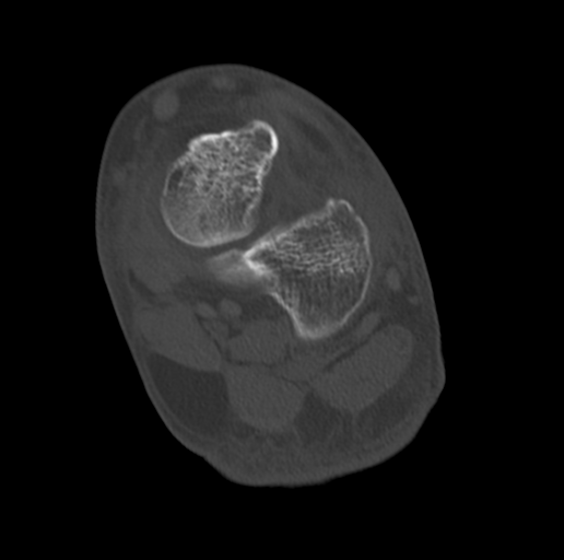 File:Anterior calcaneal process fracture (Radiopaedia 47384-51989 Coronal bone window 54).png