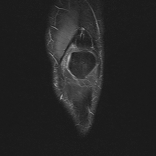 File:Anterior cruciate ligament full thickness tear (Radiopaedia 66268-75467 Coronal STIR 3).jpg