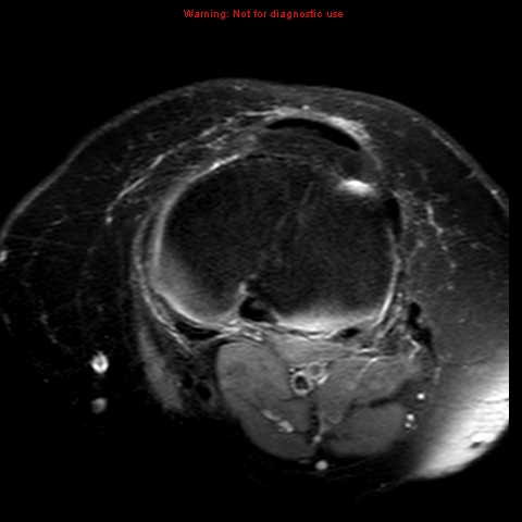 File:Anterior cruciate ligament tear (Radiopaedia 12329-12612 Axial T2 fat sat 7).jpg
