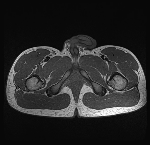 File:Anterior inferior iliac spine avulsion fracture (Radiopaedia 81312-95000 Axial T1 3).jpg