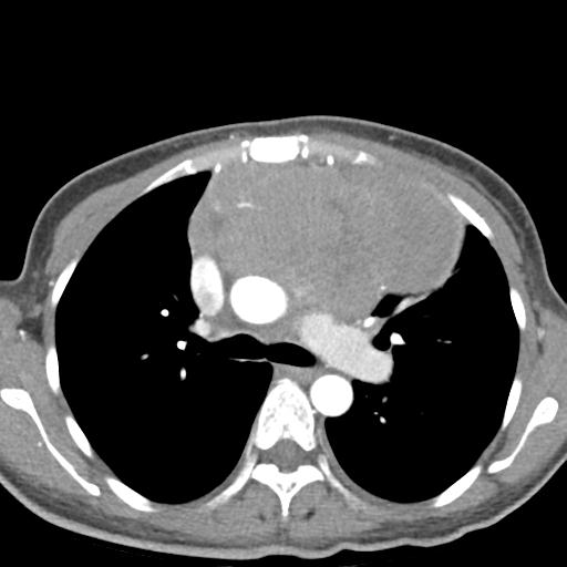 File:Anterior mediastinal lymphoma (Radiopaedia 29556-30061 C 21).jpg