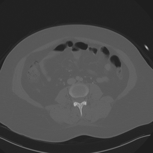 Anterior superior iliac spine avulsion fracture (Radiopaedia 44541-48244 Axial bone window 56).png