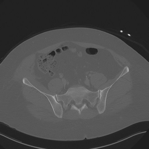 File:Anterior superior iliac spine avulsion fracture (Radiopaedia 44541-48244 Axial bone window 74).png