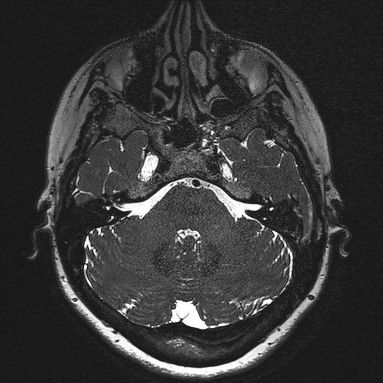 Anterior temporal encephalocele (Radiopaedia 82624-96808 Axial T2 high res 21).jpg
