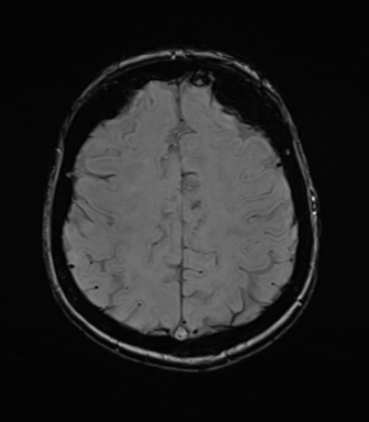 File:Anterior temporal lobe perivascular space (Radiopaedia 40946-43650 Axial SWI 65).png