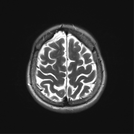 File:Anterior temporal lobe perivascular space (Radiopaedia 40946-43650 Axial T2 32).png