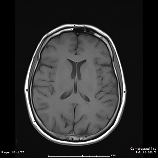 File:Anterior temporal lobe perivascular space (Radiopaedia 88283-104914 Axial T1 18).jpg