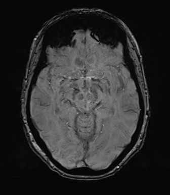 Anterior temporal pole cysts (Radiopaedia 46629-51102 Axial SWI 39).png
