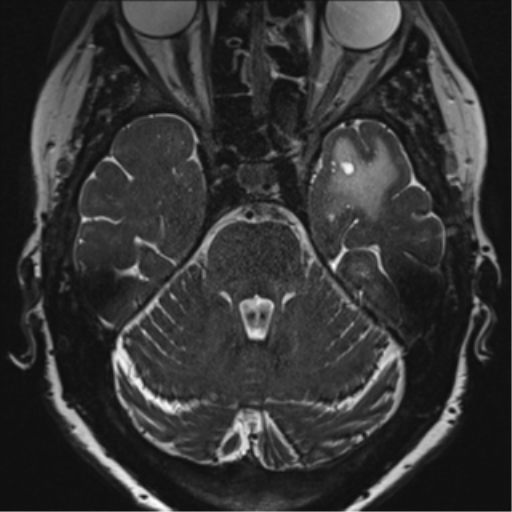 Anterior temporal pole cysts (Radiopaedia 46629-51102 Axial T2 55).png