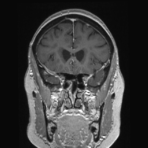 Anterior temporal pole cysts (Radiopaedia 46629-51102 Coronal T1 C+ 121).png