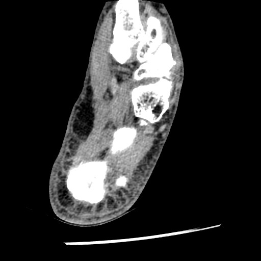Anterior tibial artery false aneurysm (Radiopaedia 88984-105809 A 209).jpg