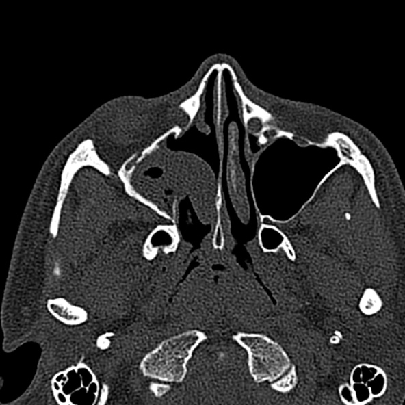 Antrochoanal polyp (Radiopaedia 30002-30554 Axial bone window 28).jpg