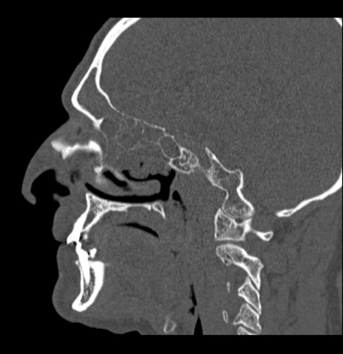 Antrochoanal polyp (Radiopaedia 79011-92169 Sagittal bone window 43).jpg
